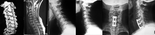 Anterior Cervical Decompression Fusion