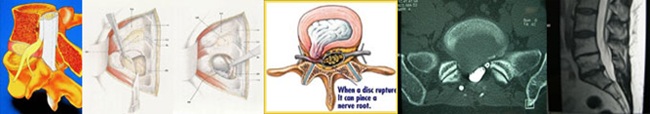 Lumbar Discectomy