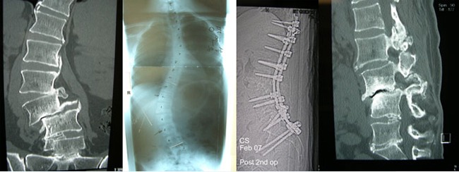 Spinal Deformity Surgery